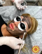 Лазерний Карбоновий пілінг