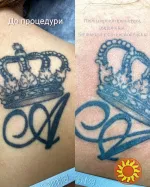 Лазерне видалення тату та Перманентного макіяжу,